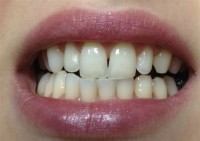 Izbjeljivanje zuba-poslije 4
